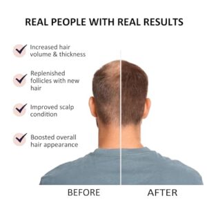 Beauty Secrets Saw Palmetto Serum for Women & Men - Reduce Hair Fall, Stimulate Growth 30ml | Natural Hair Growth Vitalizer Enriched with Redensyl, Biotin & Rosemary Oil