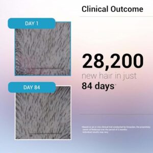 Sotrue Hair Growth Serum With 3% Redensyl - 2x Better Results than Minoxidil | 3% Procapil, 4% Anagain & 2% Baicapil | Hair Growth Actives, Hair Fall Control Serum For Women & Men, For All Hair Types, 30ml