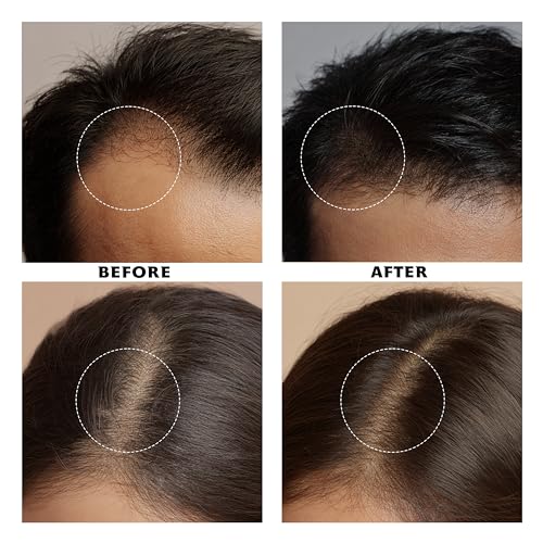 Proskire Intense Hair Growth Serum with Redensyl, Procapil, Anagain, Biotin & Ashwagandha | Boosts Hair Density & Thickness | Controls Hair Fall & Strengthens Roots | For Men & Women - 30ml each (Pack of 2)